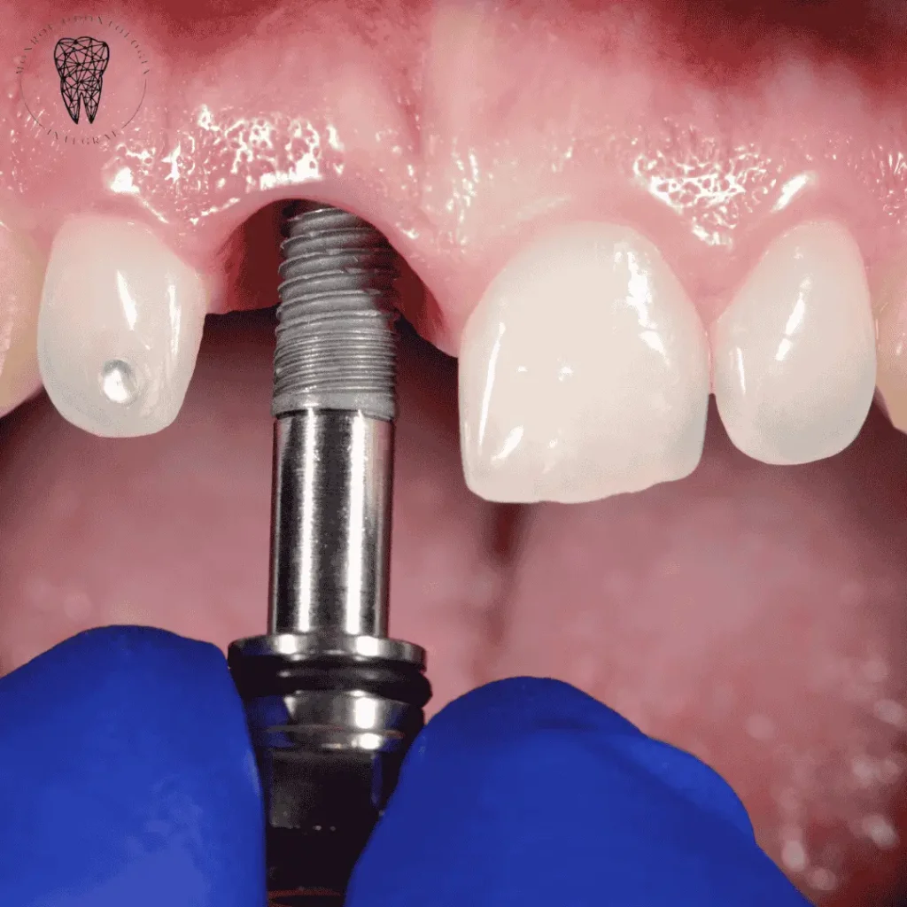 Cirugía preprotésica para implantes dentales Villa Urquiza