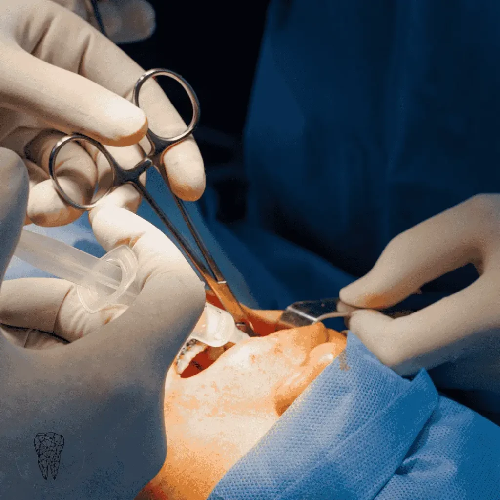 Frenectomía labial cirugía bucal en Villa Urquiza CABA