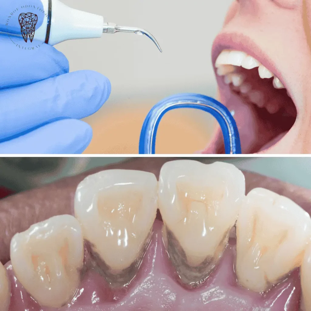 Tratamiento de limpieza y profilaxis dental Villa Urquiza
