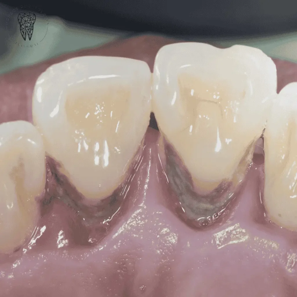 Tratamiento de periodoncia profesional en clínica dental Villa Urquiza