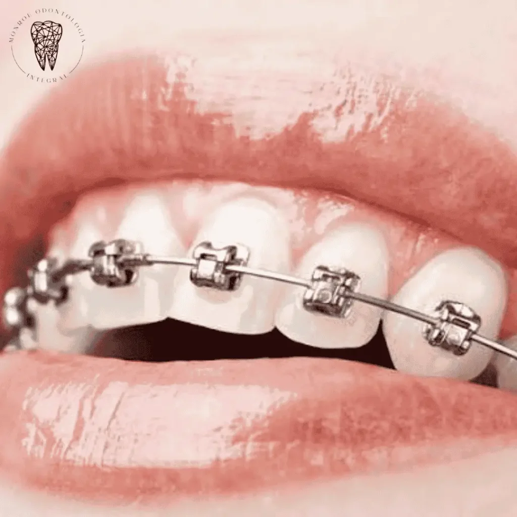 La ortodoncia autoligada es un tipo de tratamiento que utiliza brackets especiales con un mecanismo de clip o compuerta integrado que sujeta el arco, eliminando la necesidad de ligaduras (gomitas) externas. Esto permite un movimiento dental más eficiente, reduce la fricción, genera menos incomodidad y puede hacer que los tratamientos sean más rápidos.