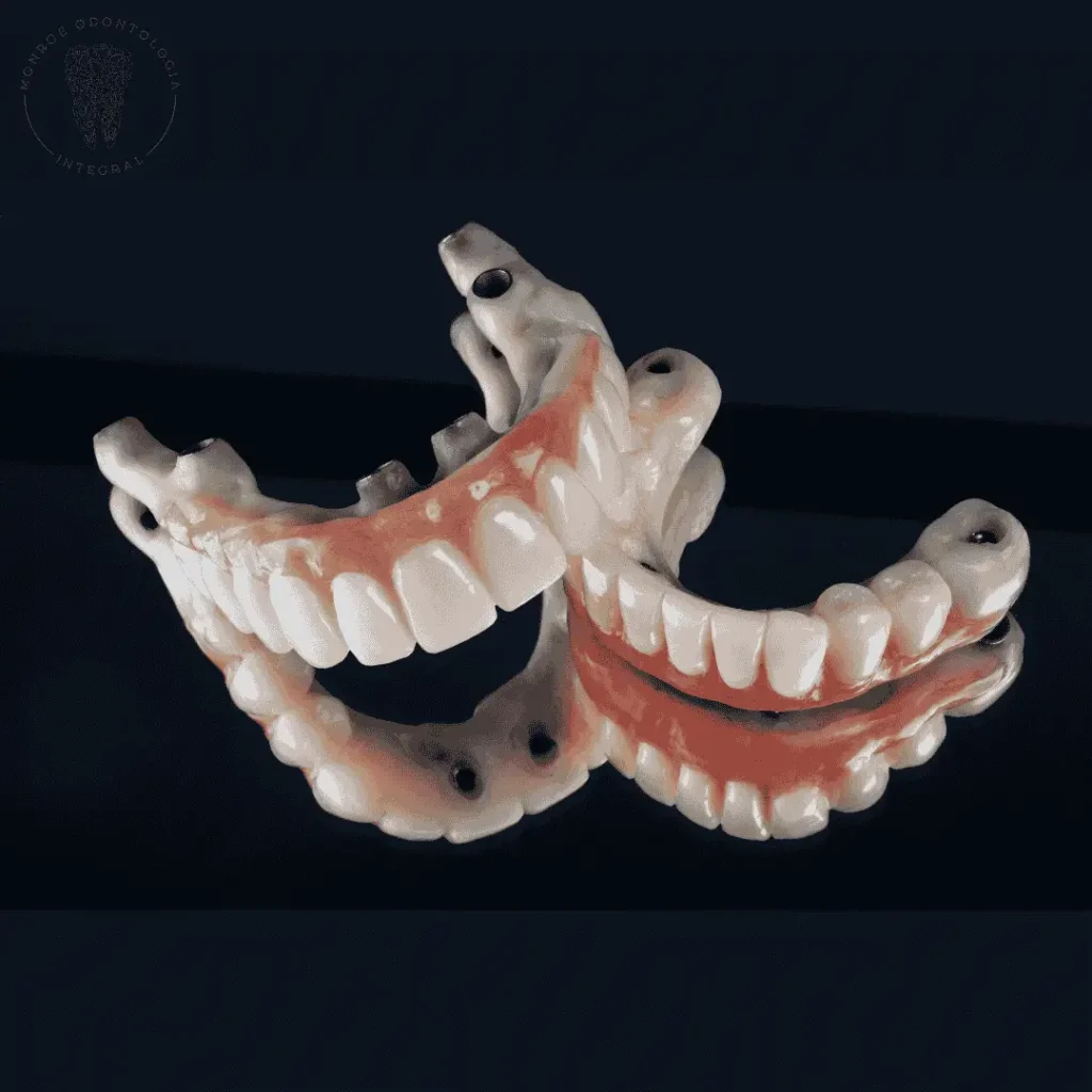 Prótesis dental fija sobre implantes All-on-4 en Villa Urquiza