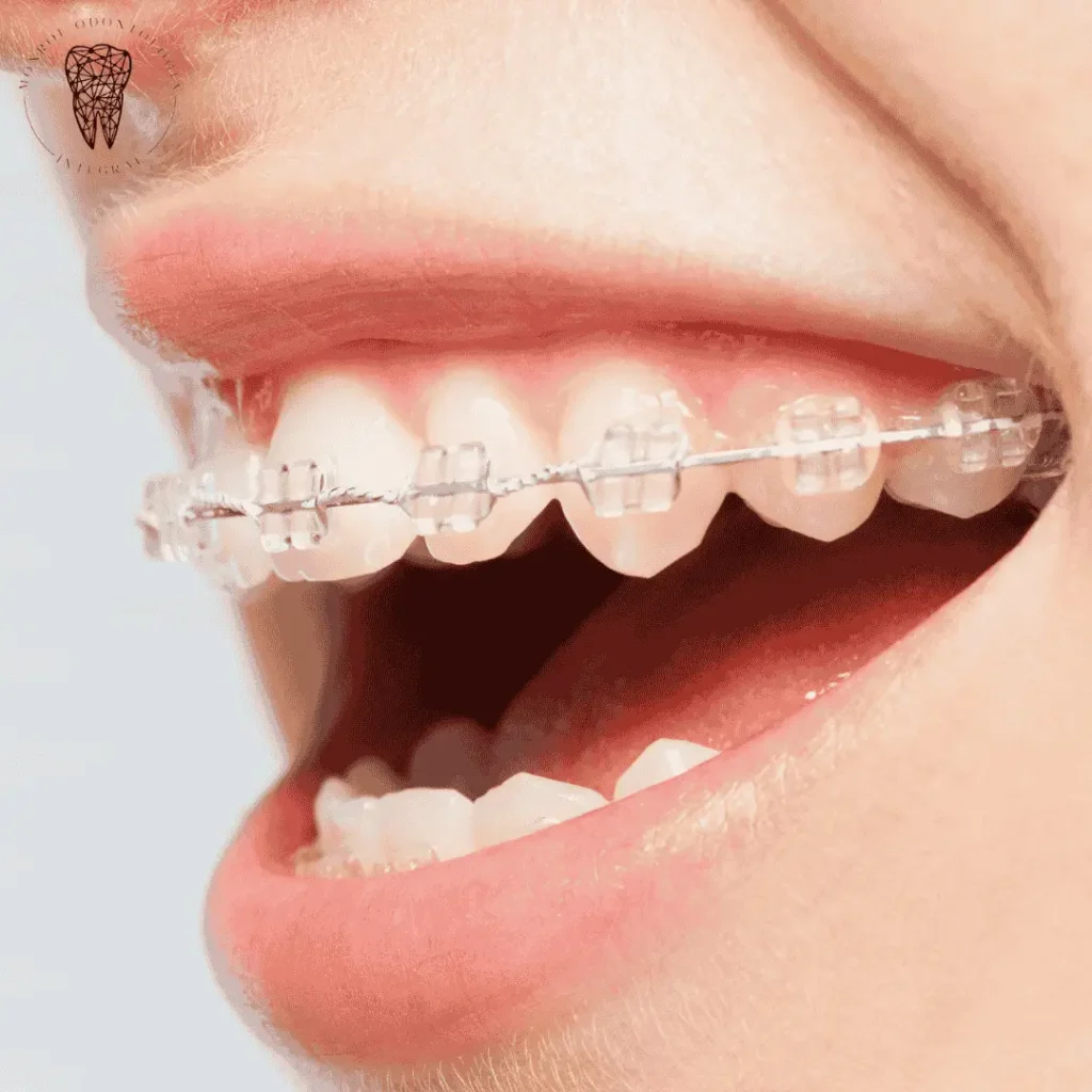 Tratamiento de ortodoncia con Brackets de Porcelana