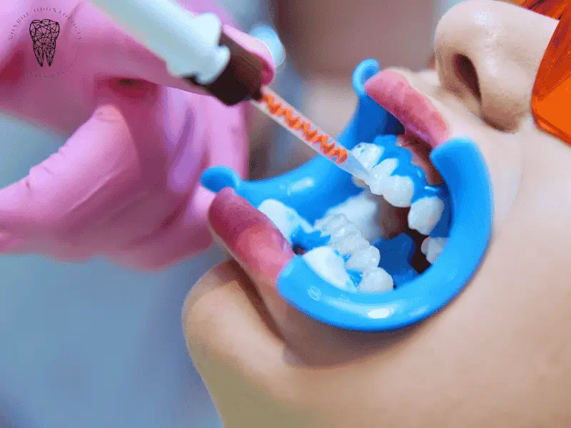 Blanqueamiento dental en Villa Urquiza paciente sonriendo Monroe Odontología Integral