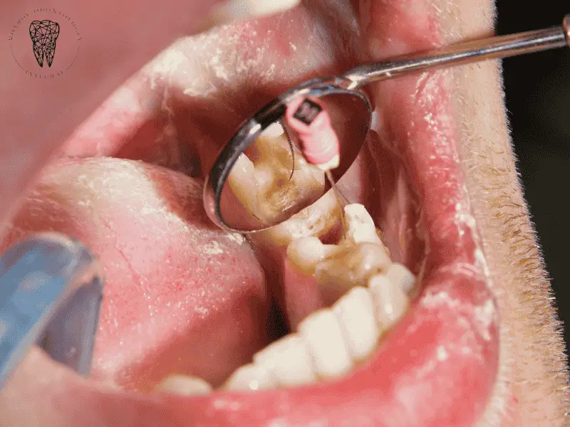 Endodoncia en Villa Urquiza