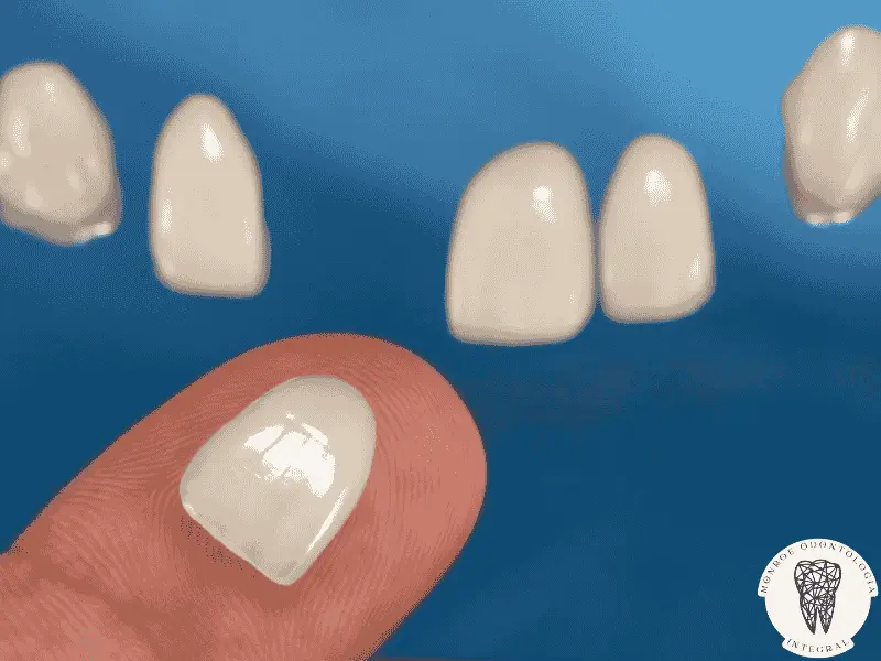 Carillas de cerámica brindan una sonrisa perfecta y duradera. Conocé sus ventajas y cuidados necesarios.