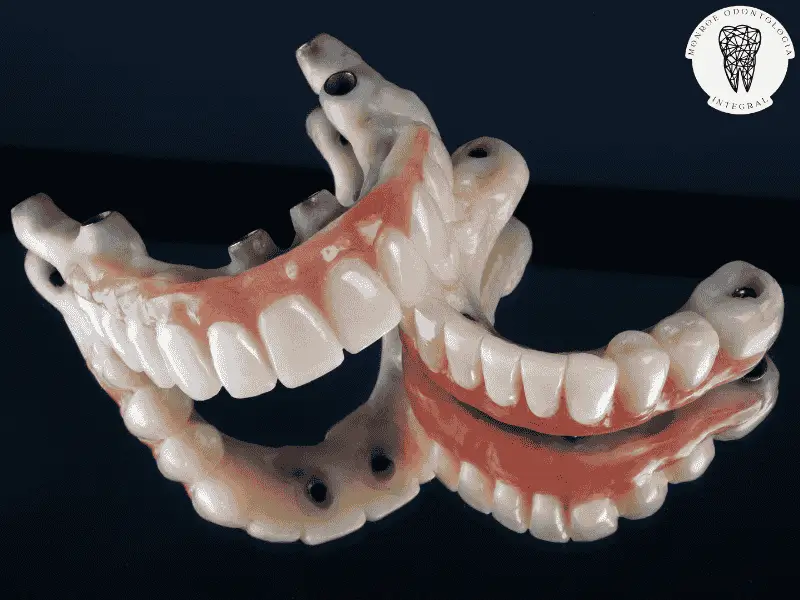 Prótesis híbrida sobre implantes ofrece dientes fijos que transforman tu sonrisa y calidad de vida