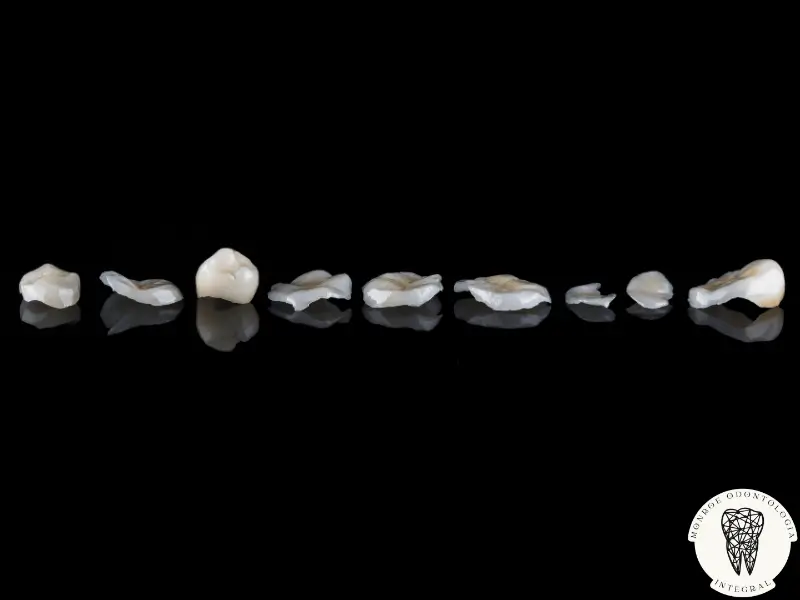 Las incrustaciones de cerámica son una alternativa estética y conservadora a las coronas dentales, perfectas para restaurar dientes dañados sin comprometer su estructura. Este tratamiento dental permite reparar muelas fracturadas, ofreciendo una solución duradera y visualmente atractiva. En este artículo, exploraremos las diferencias clave entre las incrustaciones y las coronas, cómo se realizan, y los beneficios que aportan a la estética dental. Descubre por qué cada vez más pacientes en Villa Urquiza optan por esta opción innovadora.