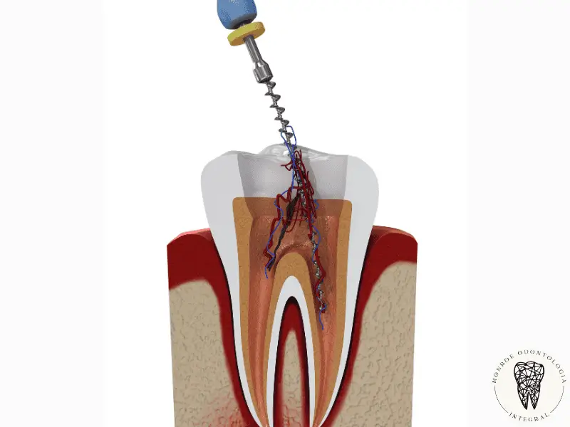 Retratamiento de conducto: conoce las causas del dolor en un diente tratado y cómo evitar la extracción dental.