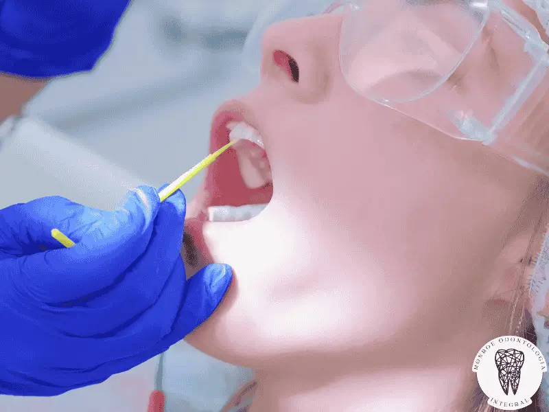 Topicación con flúor en niños: escudo contra caries efectivas