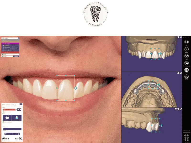 El diseño digital de sonrisas está revolucionando la odontología moderna al permitir tratamientos más precisos y rápidos. Esta tecnología avanzada, que incluye software como Exocad, transforma la forma en que los dentistas diseñan y fabrican prótesis dentales 3D. Los pacientes ahora disfrutan de una experiencia más cómoda y personalizada, con resultados que se adaptan a sus necesidades estéticas. Si deseas conocer cómo esta innovación está cambiando el panorama dental, sigue leyendo para descubrir todos los beneficios y aplicaciones del diseño digital de sonrisas.
