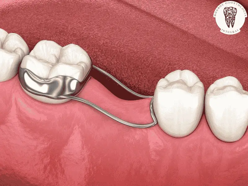 El mantenedor de espacio en niños es esencial tras la pérdida de dientes de leche. Conocé su importancia y soluciones efectivas.