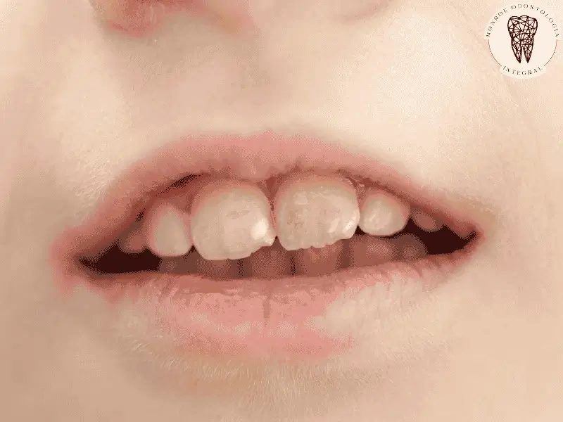 Hipomineralización Inciso Molar: descubre sus causas y soluciones para prevenir problemas dentales en los niños.