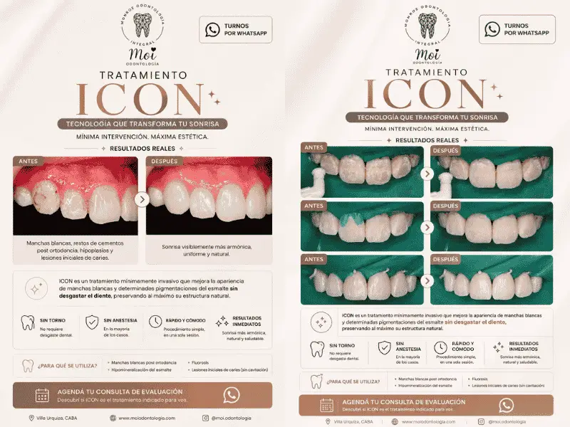 Tratamiento ICON para manchas blancas en dientes sin dolor y sin desgaste. Resultados estéticos inmediatos en una sola sesión.