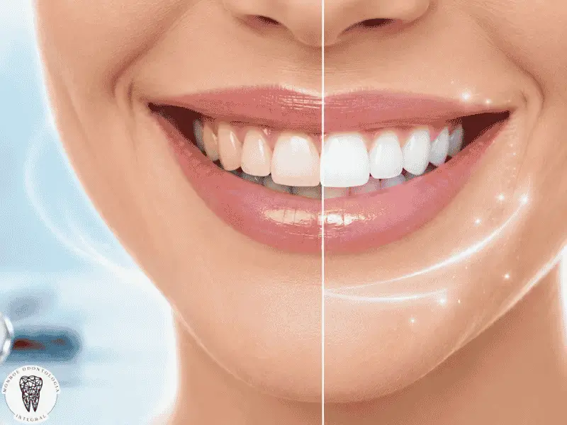 El blanqueamiento dental se ha convertido en un tema de debate popular, con mitos y realidades que generan confusión. Este artículo explora si el blanqueamiento dental realmente daña tus dientes y qué métodos son seguros. Descubre la verdad detrás de los tratamientos profesionales y caseros, así como los efectos en la sensibilidad dental y el esmalte. Aprende a diferenciar entre información veraz y mitos para tomar decisiones informadas sobre tu salud dental y estética. ¡Sigue leyendo para obtener toda la información necesaria!