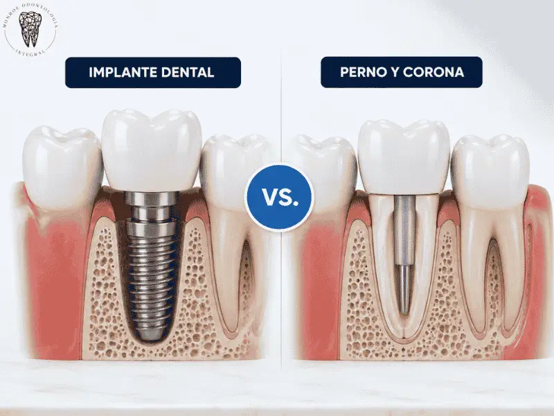 Diferencia entre implante y perno y corona dental: características y cuándo elegir cada uno para un tratamiento dental eficaz.