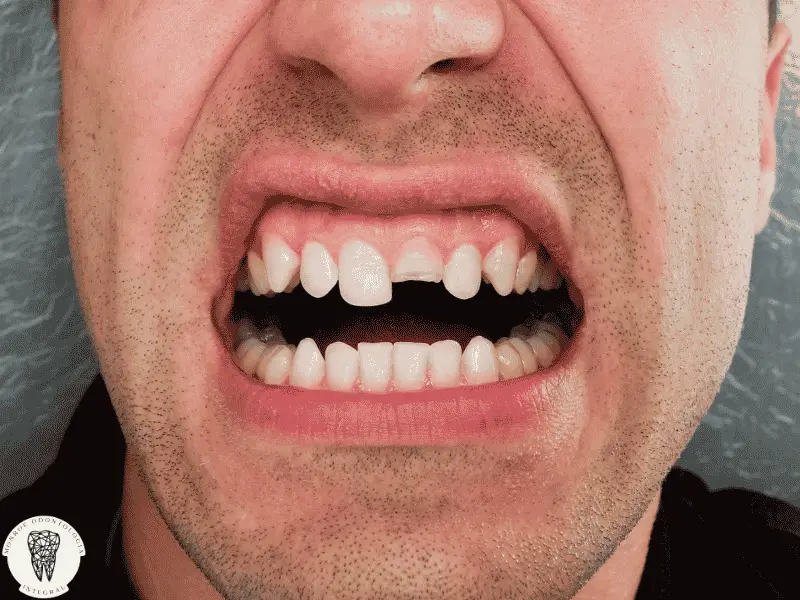 Estabas comiendo, mordiste algo duro, o te pegaste un golpe, y de golpe sentiste ese crac que te heló la sangre. Pasás la lengua por el diente y notás un borde raro, un pedazo que falta o directamente un hueco. Y en un segundo la cabeza se te llena de preguntas: ¿me lo van a sacar?, ¿voy a necesitar un implante?, ¿cuánto me va a costar?